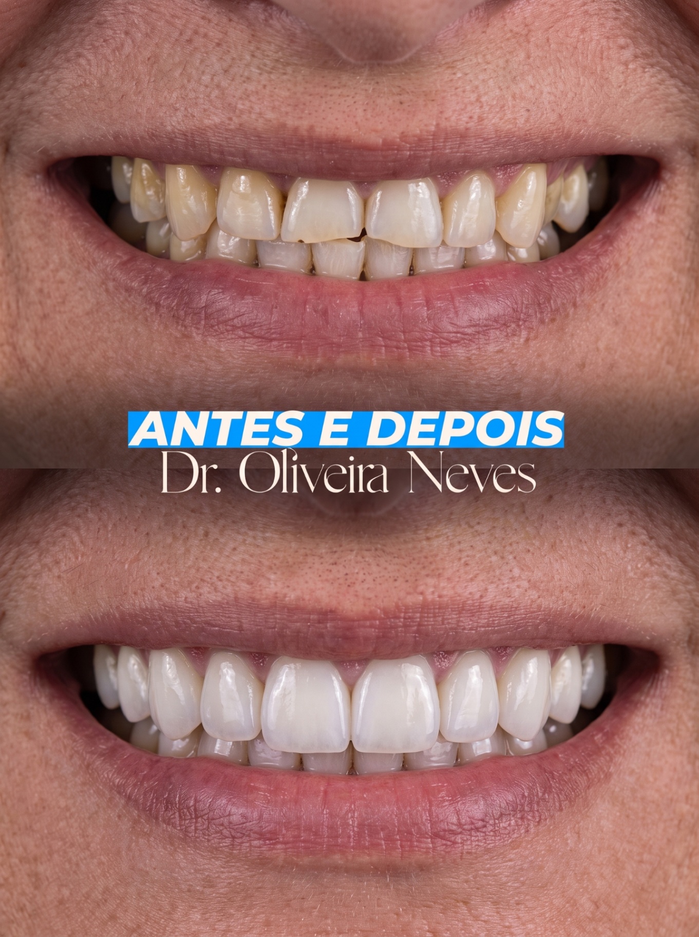 Antes e depois — caso clínico 1 · Dr. Oliveira Neves