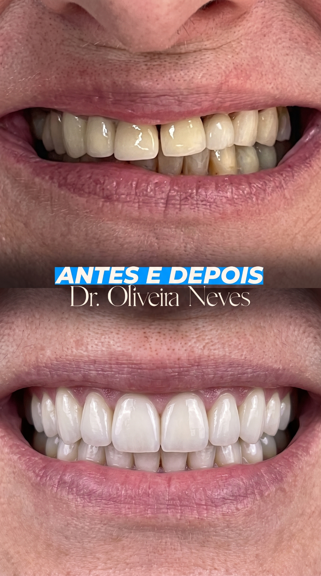 Antes e depois — caso clínico 6 · Dr. Oliveira Neves