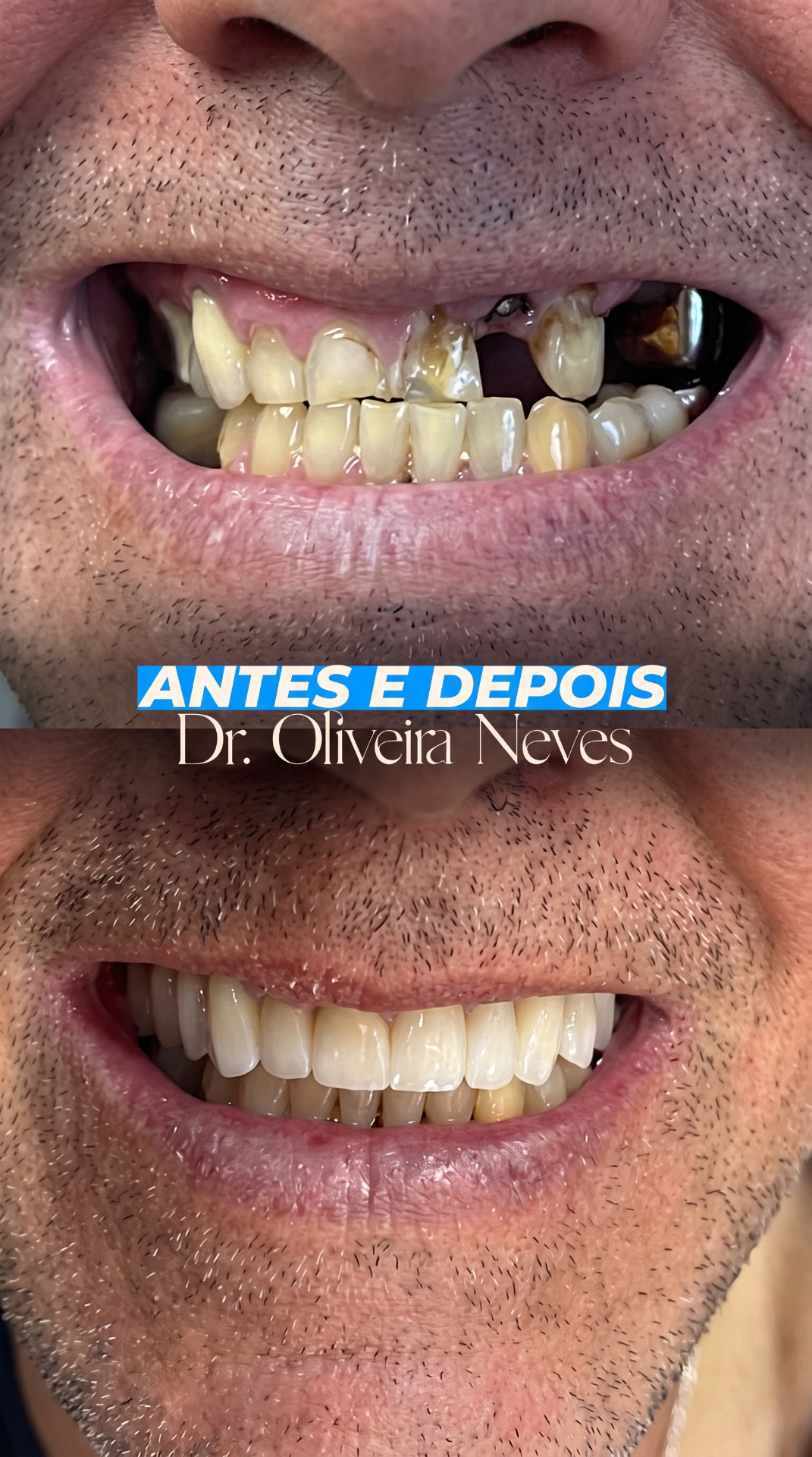 Antes e depois — caso clínico 2 · Dr. Oliveira Neves