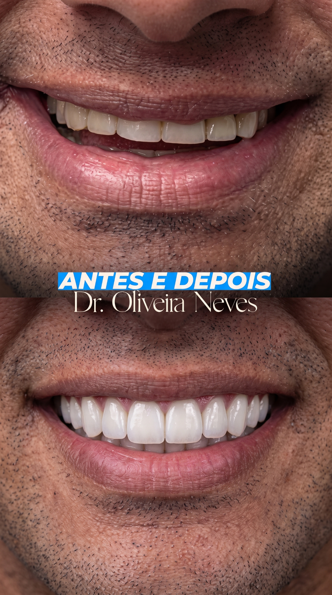 Antes e depois — caso clínico 5 · Dr. Oliveira Neves